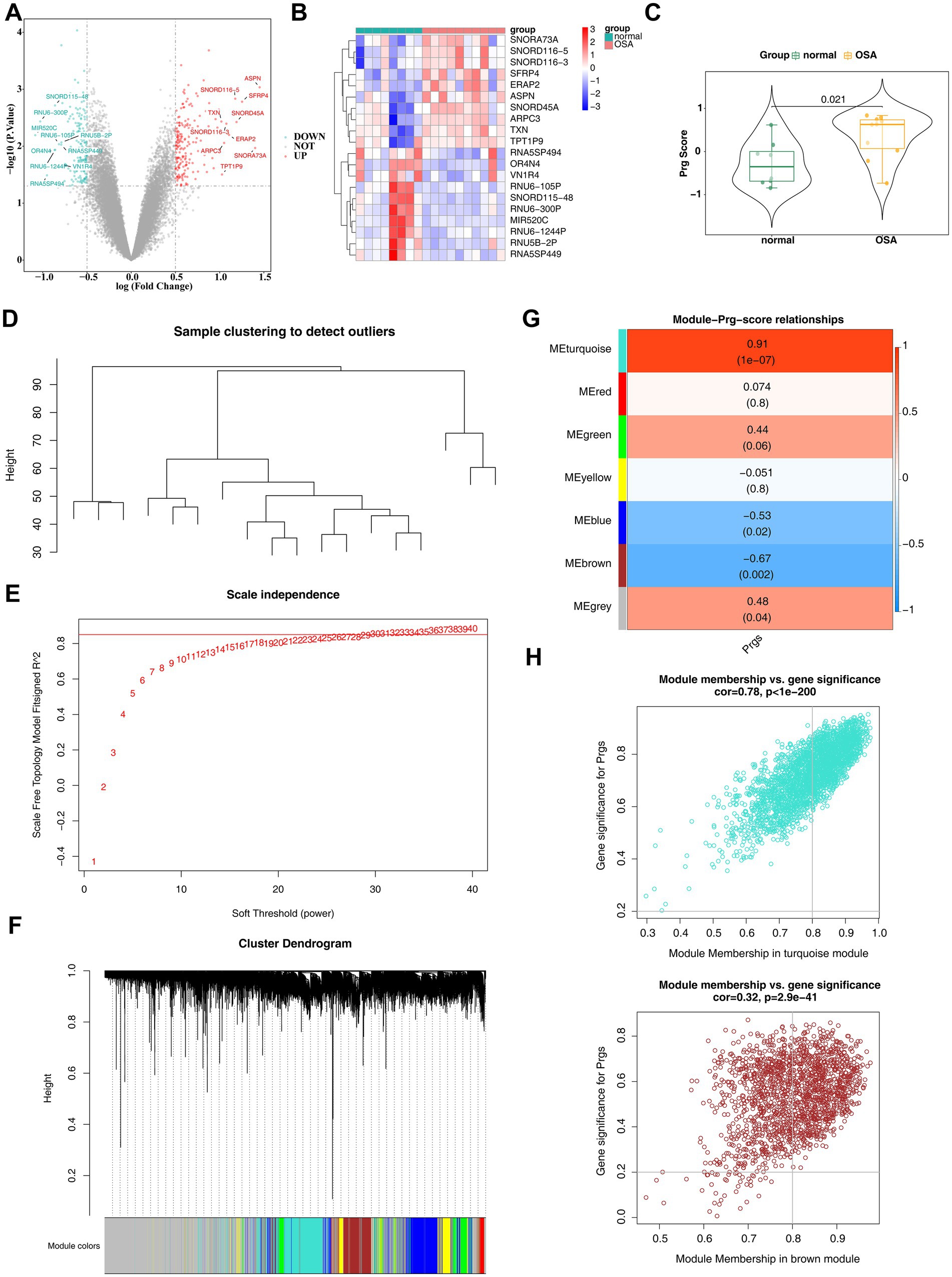 A composite image shows various graphs and charts related to genetic data analysis. Panel A is a volcano plot highlighting significant genes. Panel B is a heatmap illustrating gene expression across samples. Panel C is a violin plot comparing two groups, normal and OSA, with statistical significance. Panel D is a dendrogram for clustering analysis. Panel E displays a plot of scale independence. Panel F is a cluster dendrogram with module color assignments. Panel G is a heatmap of module correlations with Prg score. Panel H features two scatter plots showing relationships between module membership and gene significance.