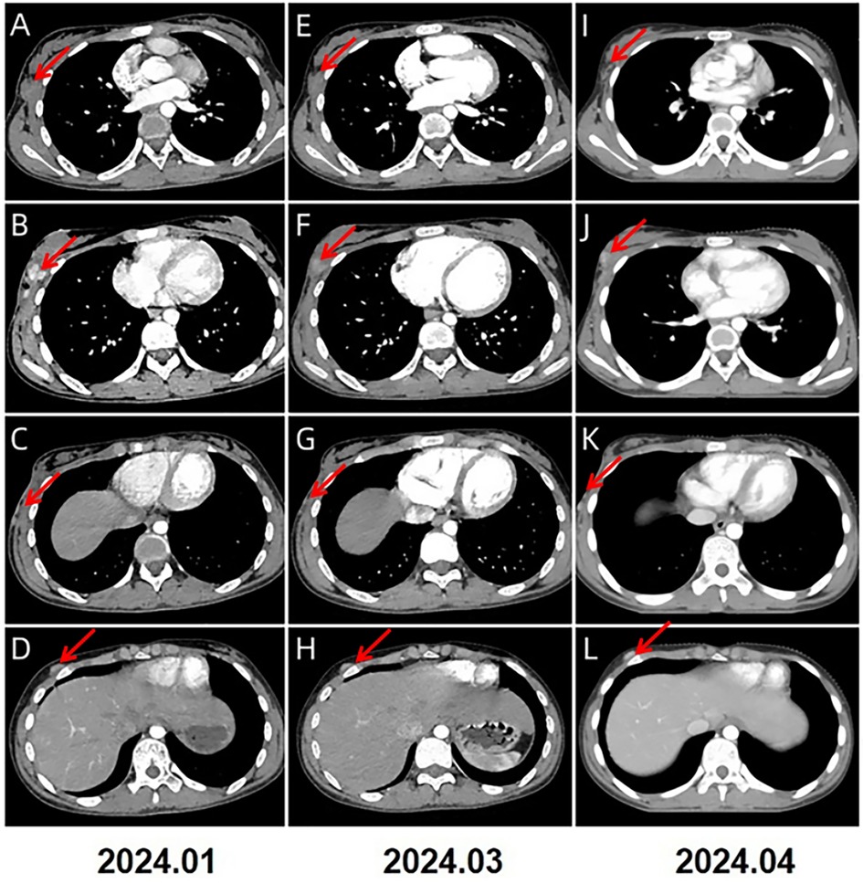 Twelve axial CT scan images labeled A to L show progression of a pulmonary condition. Each row represents scans from different months: January 2024, March 2024, and April 2024. Red arrows highlight areas of interest, indicating changes or developments in the scan images over time.