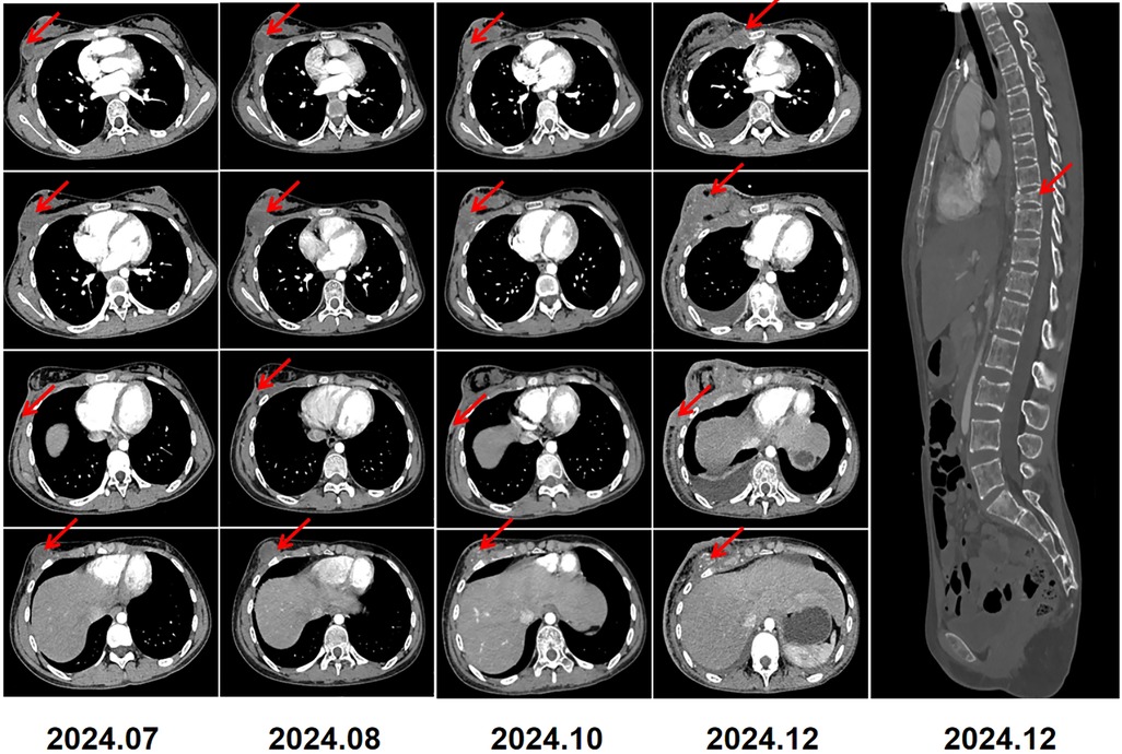 CT scan images showing cross-sectional views of the chest and abdomen over time, marked with red arrows indicating areas of interest. The images are from July, August, October, and December 2024. The series includes a side view from December 2024 highlighting the spine.