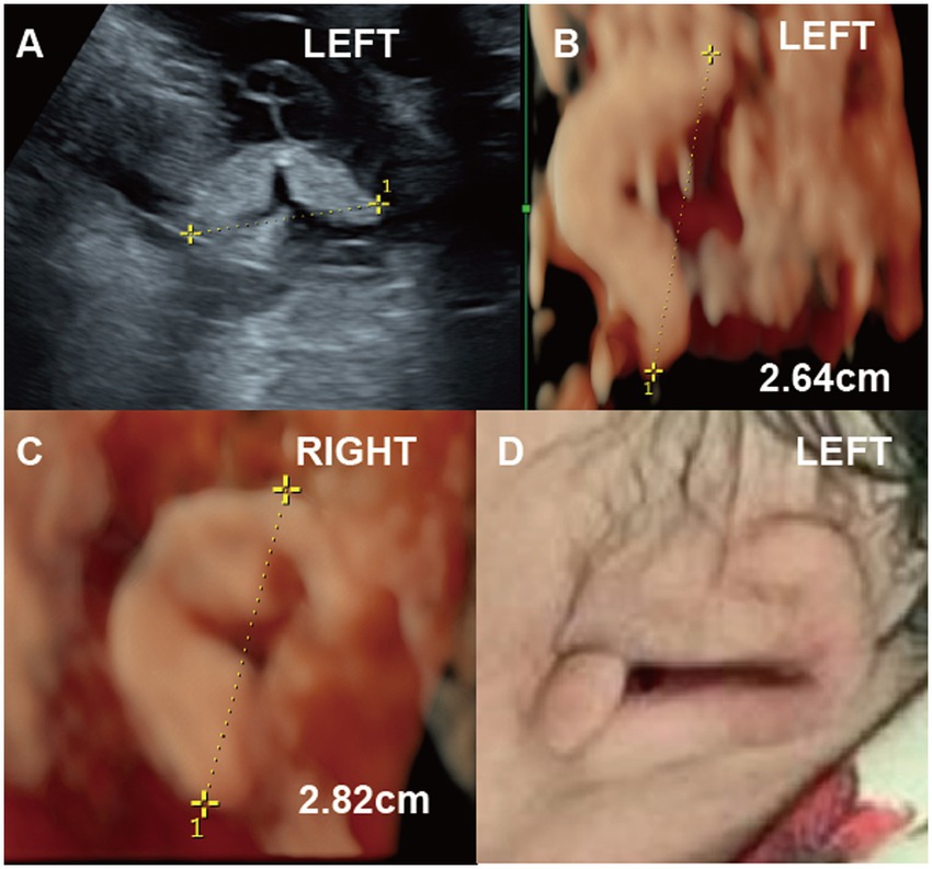 Panel of four medical images labeled A, B, C, and D, showing ultrasound and 3D scans of ears. Image A and B are on the left side with measurement marking 2.64 centimeters. Image C shows the right side measuring 2.82 centimeters. Image D is a photo of a newborn's left ear.