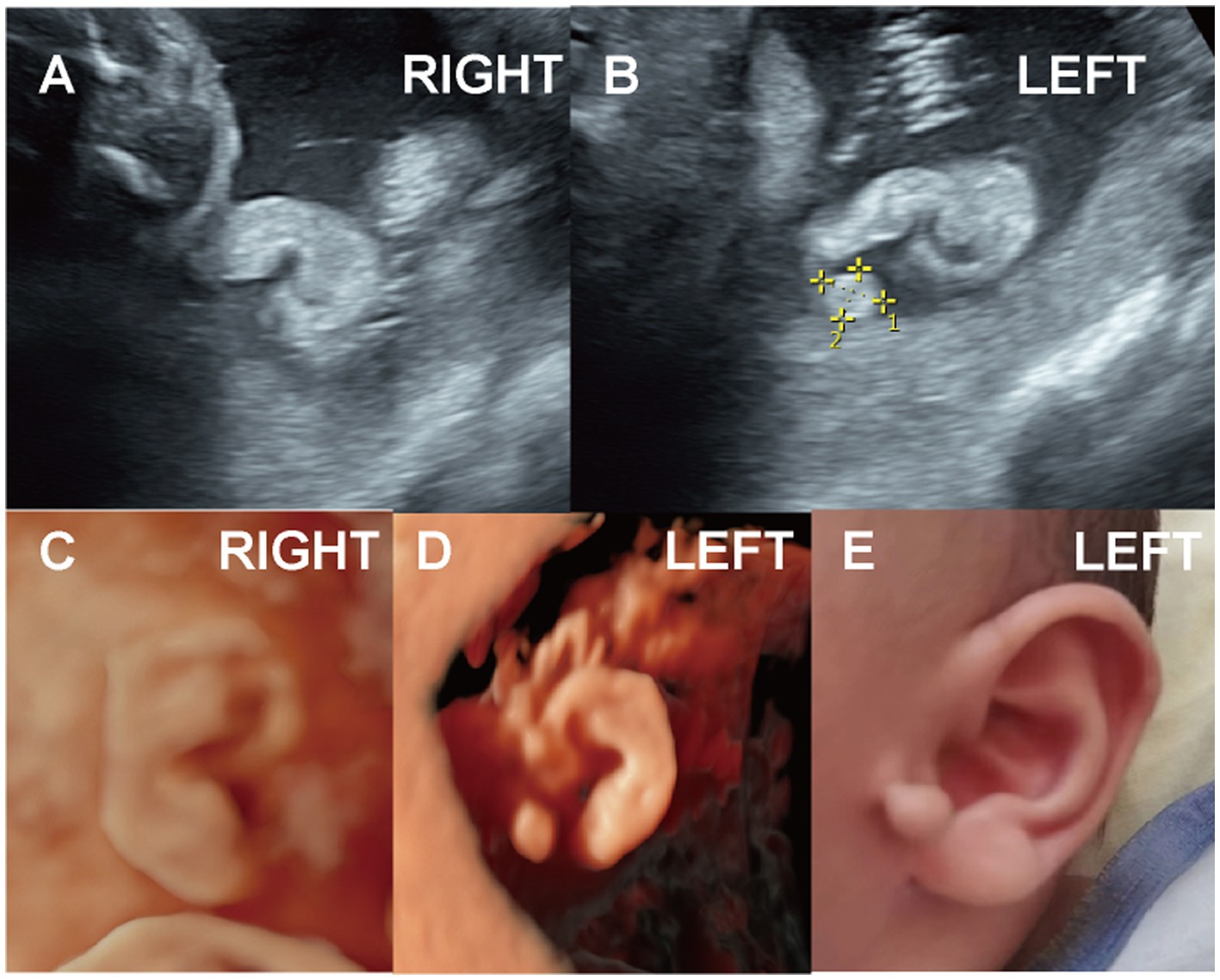 Ultrasound images labeled A and B show the right and left fetal ears, respectively. Images C and D are 3D ultrasound views of the right and left fetal ears. Image E is a postnatal photo showing the left ear of a newborn.