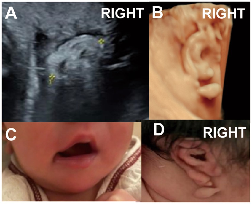 Composite image with four panels showing the development of a baby's right ear. Panel A: Ultrasound image highlighting the ear region. Panel B: Three-dimensional rendering of the ear's structure in utero. Panel C: Baby a lateral facial cleft on the right side. Panel D: Close-up of the baby's right ear after birth.