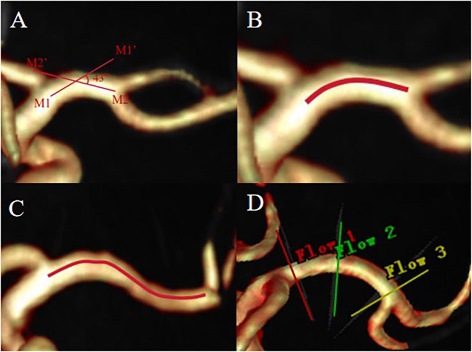Four-panel image showing blood vessels with different annotations. Panel A has several red labels marked M1, M2, E, and lines indicating intersections. Panels B and C display a highlighted curved vessel section in red. Panel D shows the red, green, and yellow lines indicate where the slice was placed at the time of measurement, not the direction of blood flow.