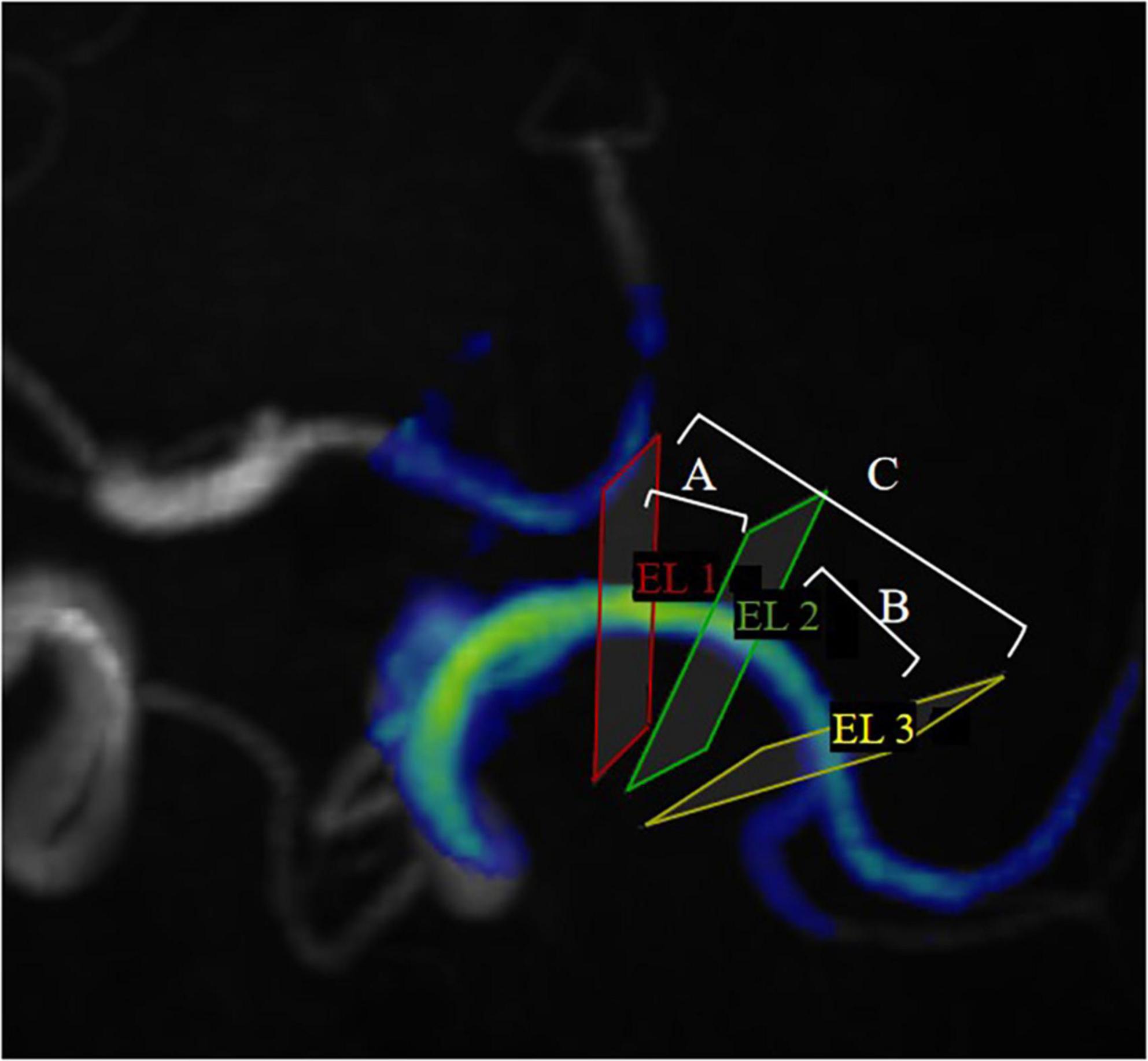 Medical imaging scan with colored annotations on a tubular structure. Three sections are marked: EL 1 in red, EL 2 in green, and EL 3 in yellow. Sections A, B, and C are indicated with white lines for reference.