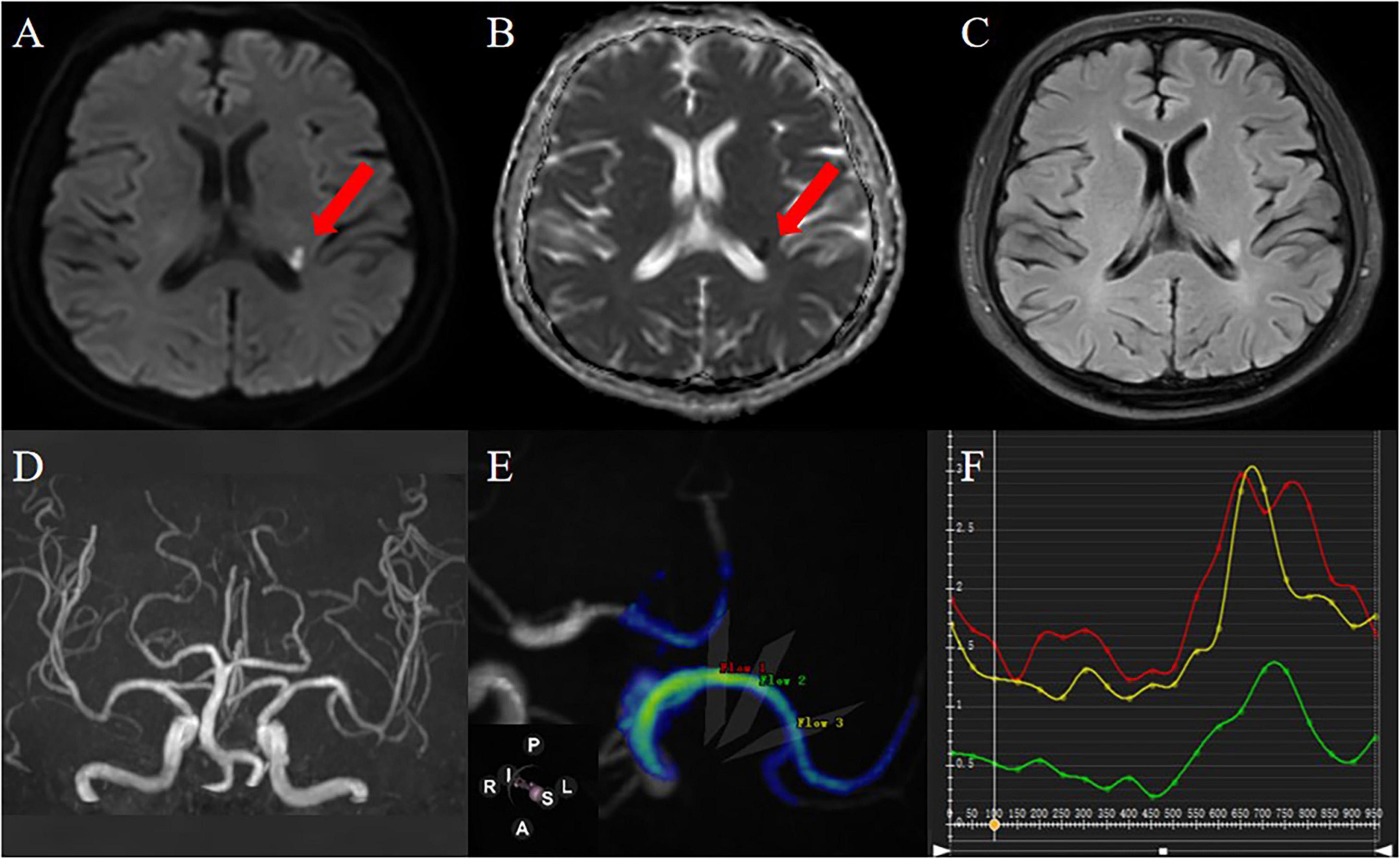 MRI images labeled A, B, and C show different brain scans with red arrows indicating specific areas. Image D displays a 3D angiography of cerebral vessels. Image E illustrates a color-coded flow map of blood circulation. Image F is a line graph with three color-coded lines representing different measurements or data over time.