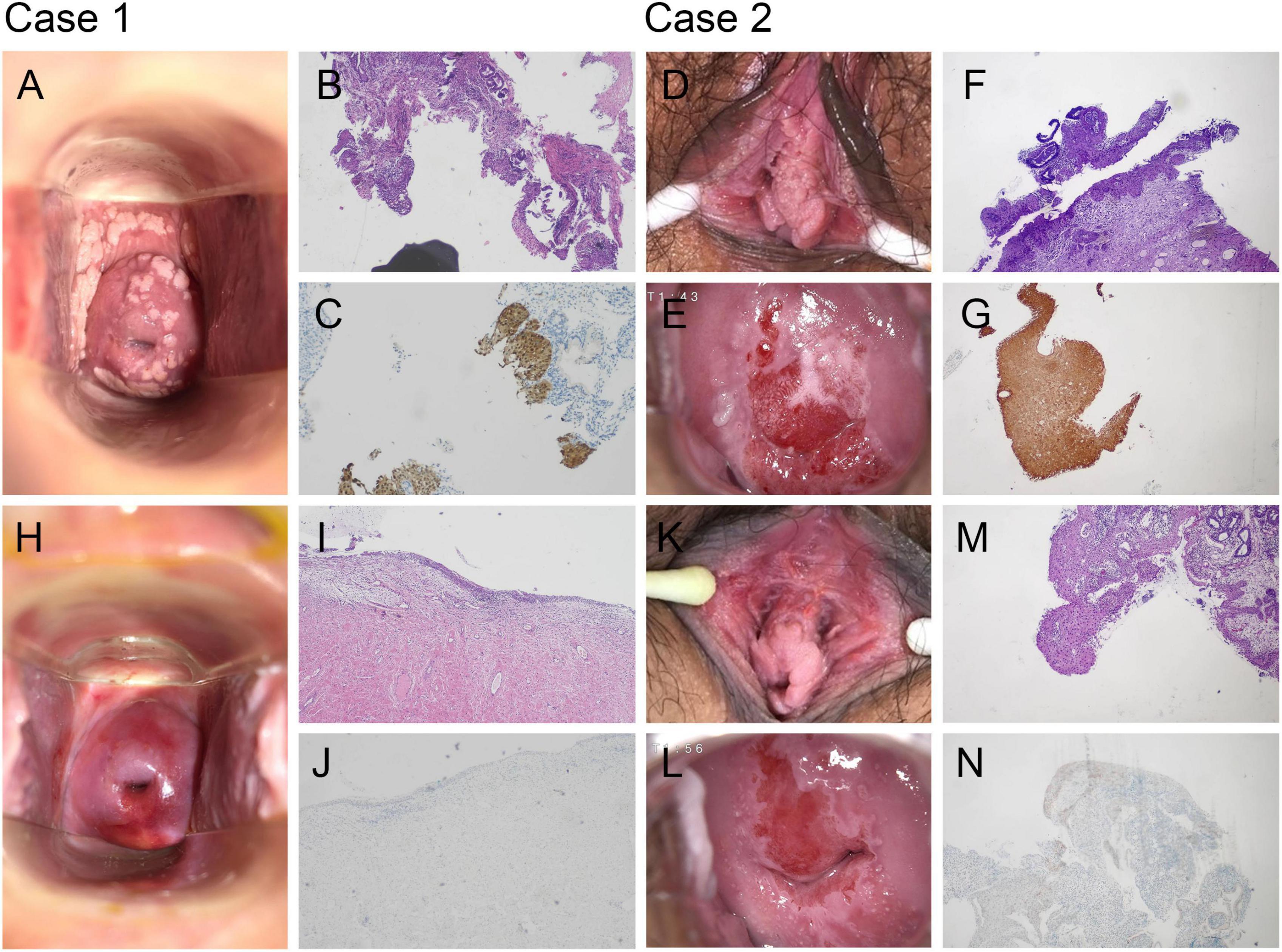 Case 1 and Case 2 display medical images. Case 1 includes images A and H of a physical condition, with B and L showing tissue histology, and C and J highlighting specific markers. Case 2 features D and K showing a similar condition, with E and L more detailed views, and F, M, G, and N showcasing histological sections with specific staining patterns.