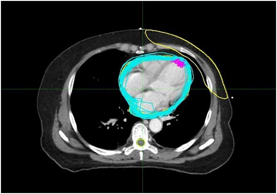 CT scan of a thoracic cross-section with color outlines highlighting specific areas. A bright cyan region encircles the heart area, while yellow outlines an area under the rib cage. Purple markings are near the top right, possibly indicating a region of interest.