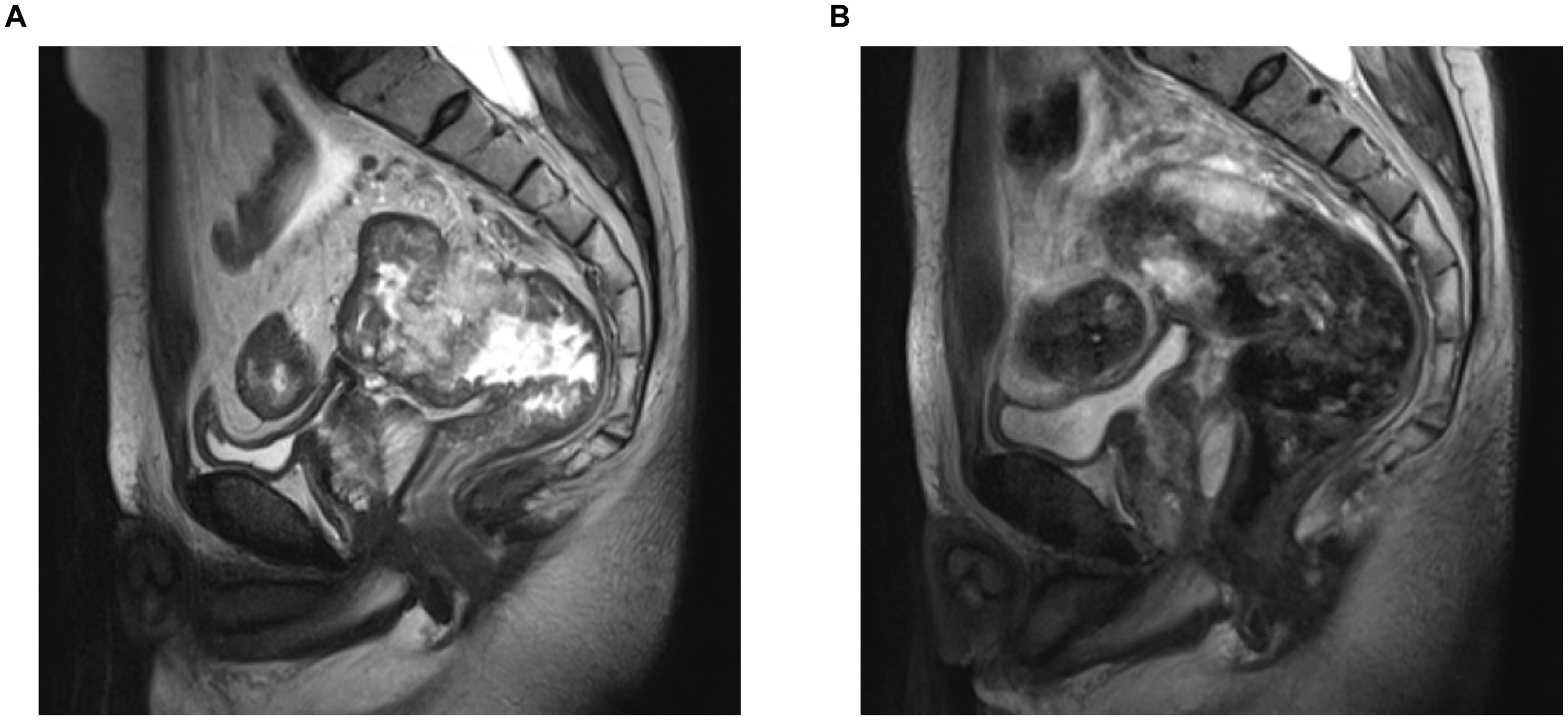 It shows the pelvic MRI images of the patient before and after NAT. Panel A: The patient had locally advanced rectal cancer with regional lymphadenopathy. Panel B: The patient experienced tumor regression after receiving NAT.