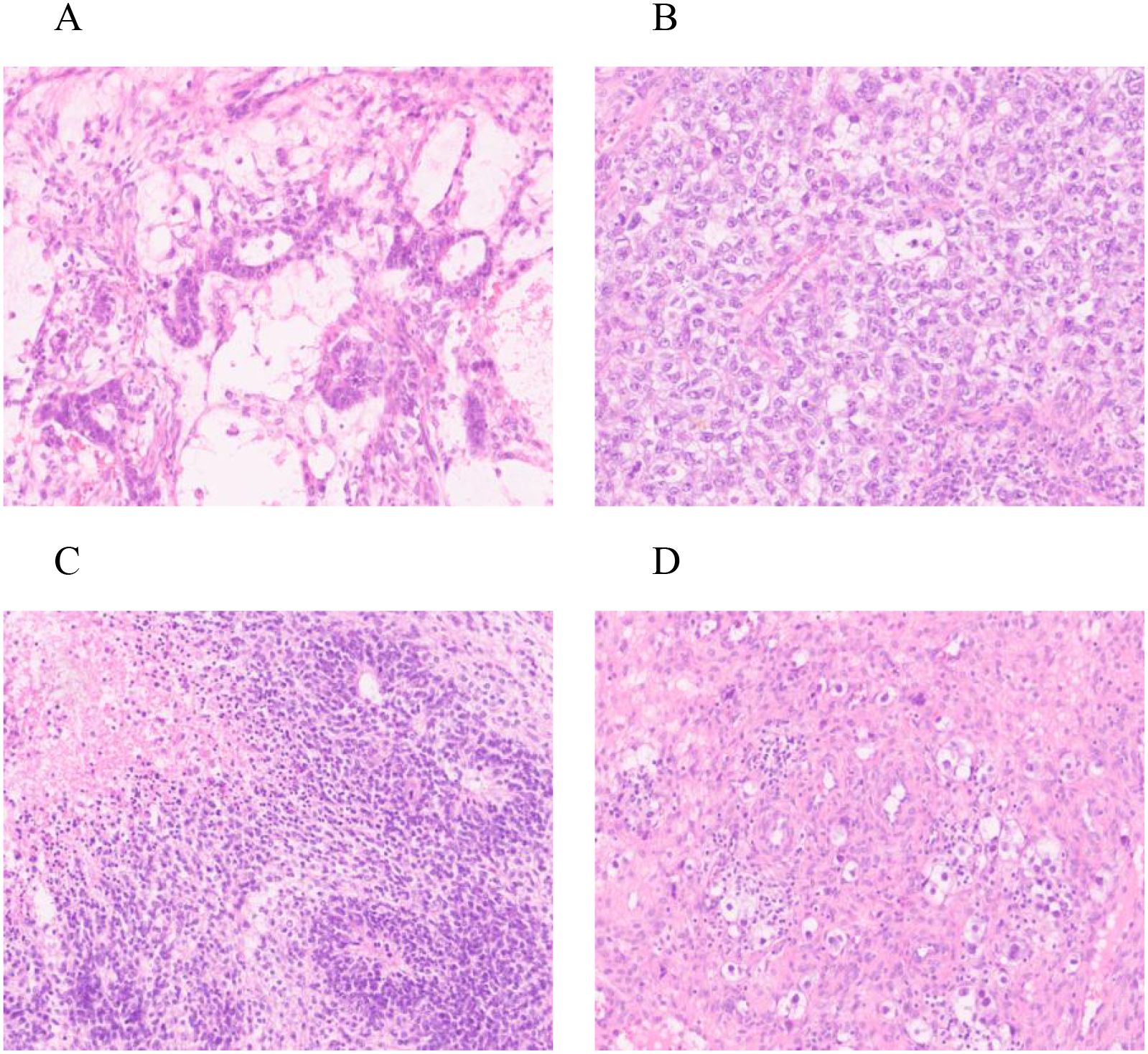 Histological images labeled A, B, C, and D show varied tissue structures under a microscope. Image A displays fibrous and irregular cell patterns. Image B shows densely packed cells. Image C reveals a high concentration of dark-stained cells. Image D illustrates a mix of lighter-staining areas and clustered cells.