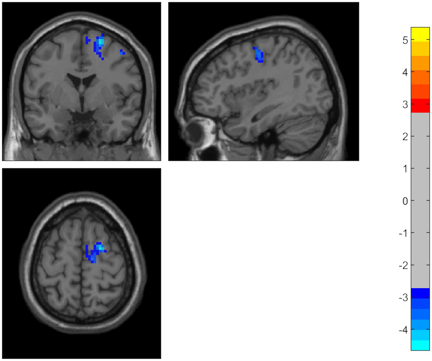 MRI brain scan with three views showing highlighted areas in blue, indicating activity in the frontal regions. A color scale on the right ranges from yellow to blue, with numeric values from 5 to -4.
