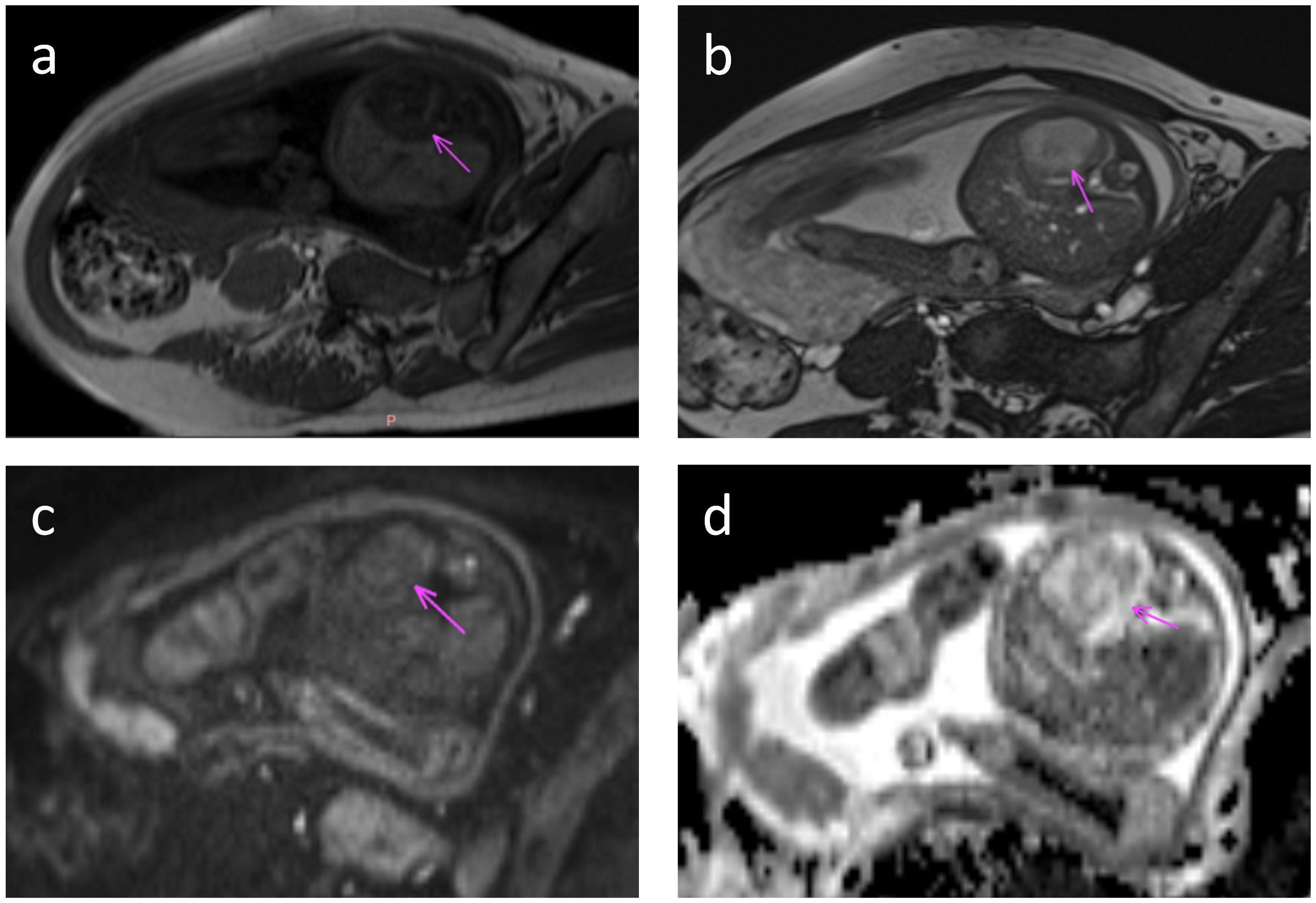 Four MRI images of a person's abdomen, labeled a, b, c, and d, show cross-sectional views. Each image has a pink arrow pointing to a specific area, indicating a region of interest within the scans. The images vary in contrast and detail, highlighting different tissue characteristics.