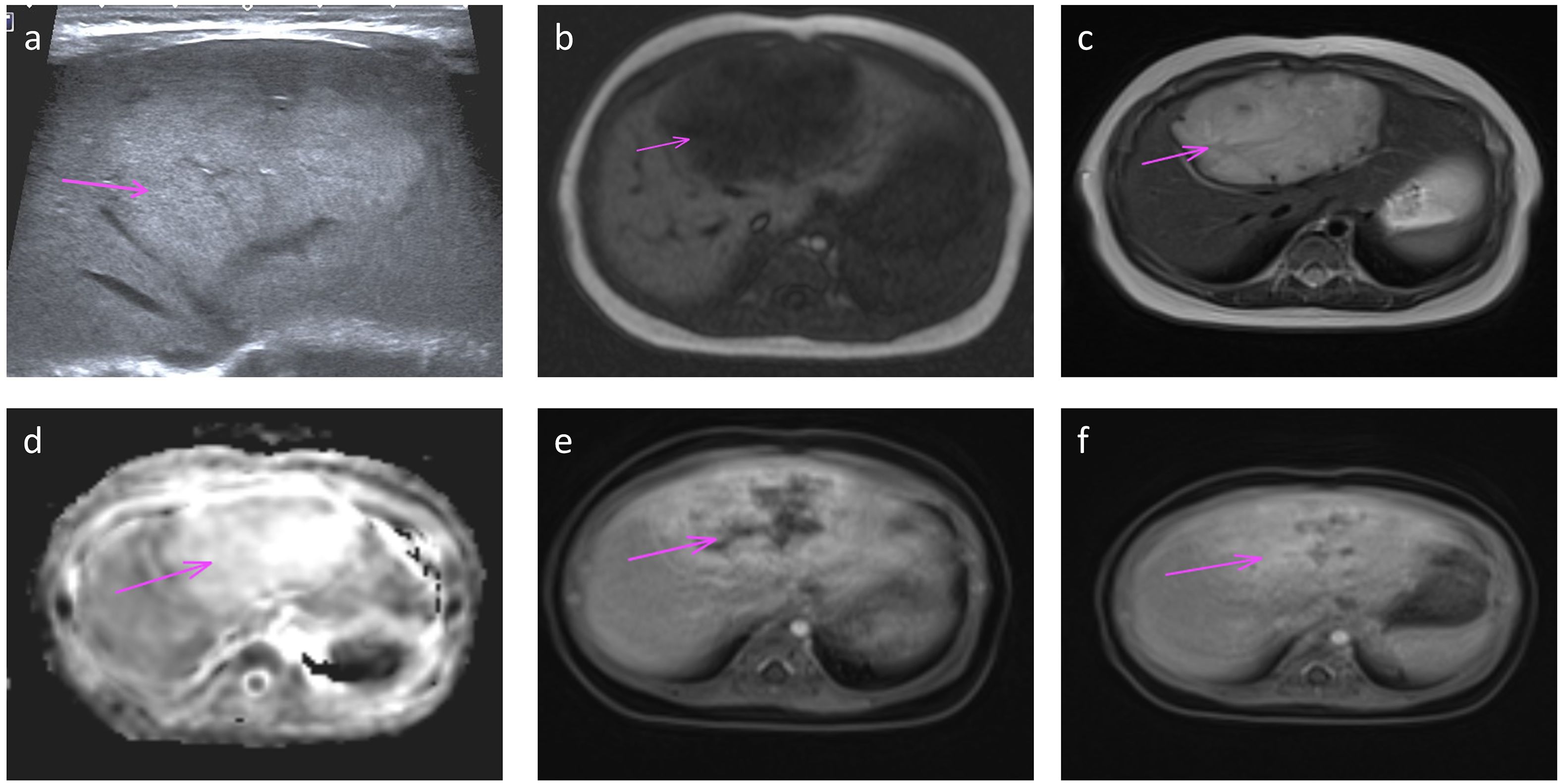 A series of medical images labeled a to f, showing various diagnostic views of a liver. Each image is marked with a purple arrow pointing to a specific area of interest, possibly indicating a lesion or abnormality within the liver tissue. The images vary in contrast and detail, suggesting different imaging techniques such as ultrasound and MRI.