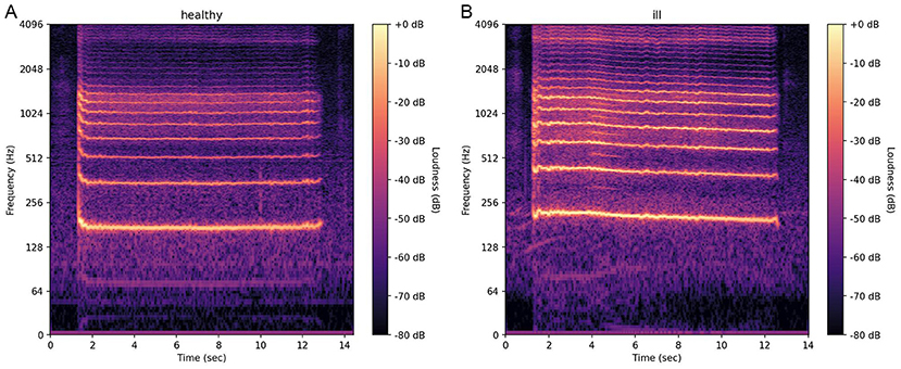 Figure 2 - Spectrograms from (A) a healthy person and (B) an ill person show the loudness (measured in decibels; dB) for each frequency (measured in Hertz; Hz) present in the voice over time.