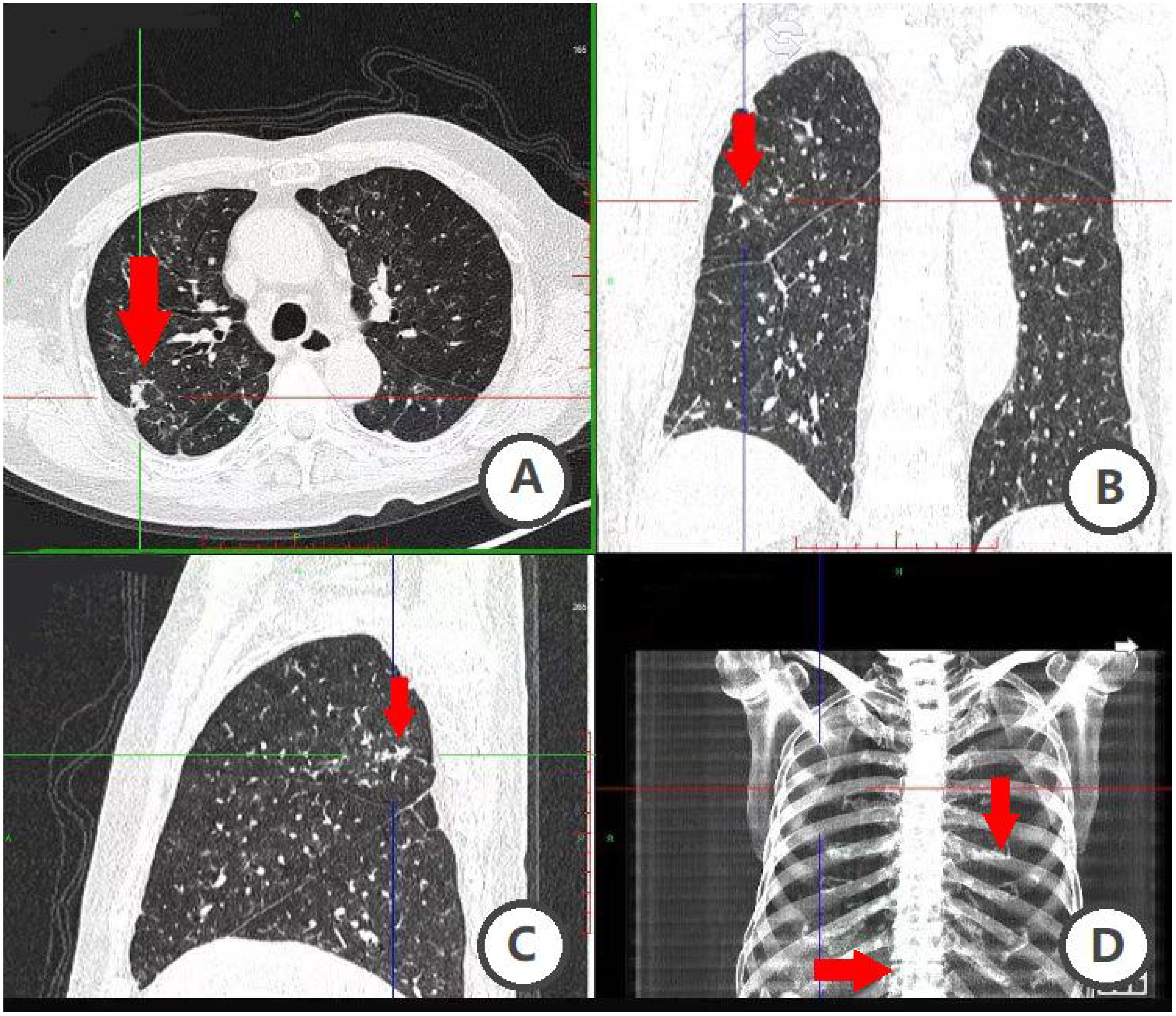 CT and X-ray images of the chest in four panels labeled A, B, C, and D. Panel A shows a transverse CT slice with an arrow indicating a detailed area in the left lung. Panel B shows a coronal CT view highlighting a region in the left lung with an arrow. Panel C displays a sagittal CT section with an arrow pointing to the lung. Panel D is an X-ray showing arrows highlighting two different points on the ribs and spine.