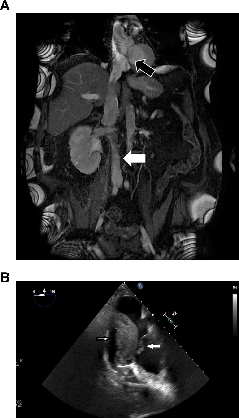 MRI image of the abdomen showing various internal organs, including the liver and kidneys, with distinct anatomical details. Below, an ultrasound image displays cardiac structures with two arrows highlighting specific areas of interest.