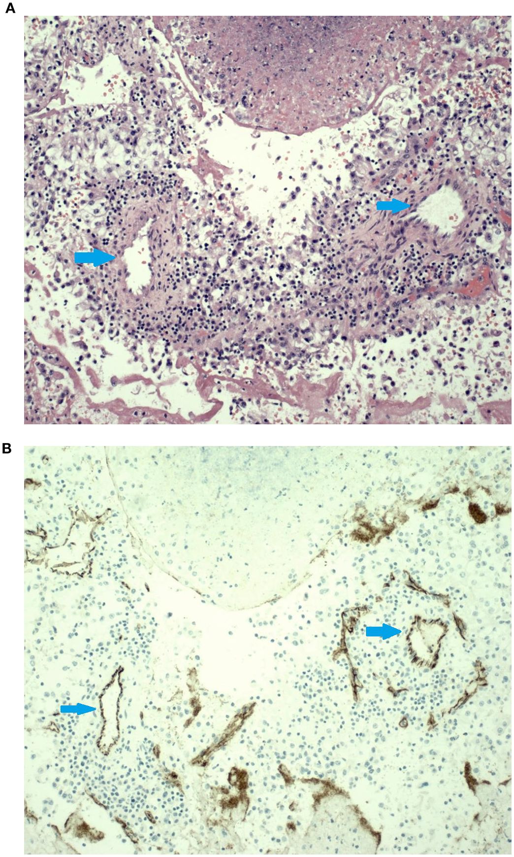 A: A large, red, irregularly shaped mass placed on a blue sterile cloth, possibly a surgical specimen. B: Microscopic view of tissue showing densely packed cells with dark nuclei, indicating a detailed cellular structure in a tissue sample.