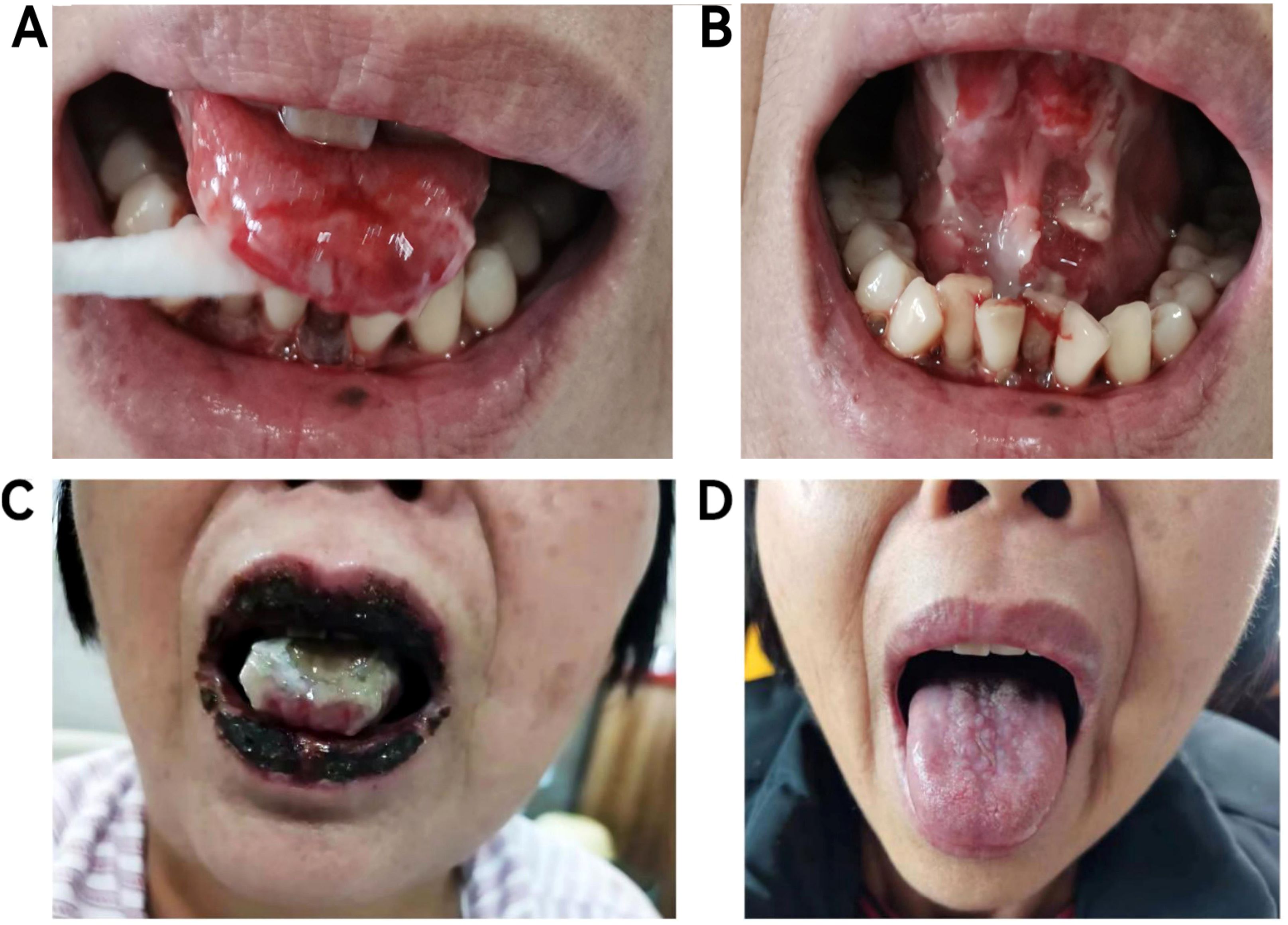 Four-panel image showing oral conditions. Panel A depicts a swollen, red tongue with sores. Panel B shows an open mouth with remnants of tissue on the palate. Panel C displays blackened lips and scarring inside the mouth. Panel D shows a protruding, healed tongue with slight discoloration.