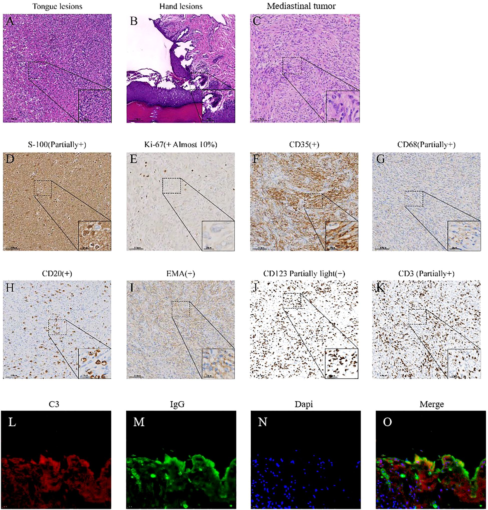 A series of microscopic images shows various tissue samples and immunohistochemical stains. Panels A, B, and C display tongue lesions, hand lesions, and a mediastinal tumor, respectively, with close-ups. Panels D to K depict immunohistochemical stains labeled as S-100, Ki-67, CD35, CD68, CD20, EMA, CD123, and CD3, highlighting different cellular markers, some noted as partially positive. Panels L, M, N, and O show fluorescence images labeled C3 in red, IgG in green, DAPI in blue, and a merged image combining these colors. Each panel includes an inset for detailed examination.