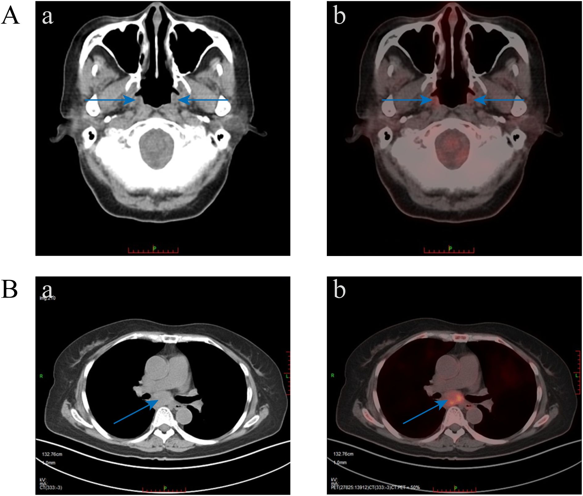 CT and PET scan images showing axial views of the head and thoracic region. Panel A: a) CT scan of the head with arrows pointing to symmetrical areas; b) PET scan overlay highlighting similar regions. Panel B: a) CT scan of the thorax with an arrow indicating a specific area near the spine; b) PET scan overlay showing increased activity in the same region.