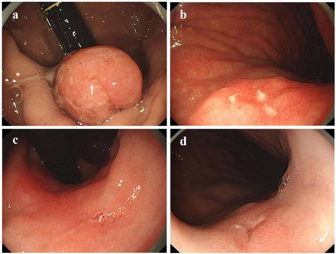 Four endoscopic images labeled a to d, showing different views of the gastrointestinal tract. Image a depicts a large, round mass. Image b shows the interior with visible ridges and redness. Image c highlights a smoother, red surface with slight abrasions. Image d presents a cleaner, lighter area with minor folds.