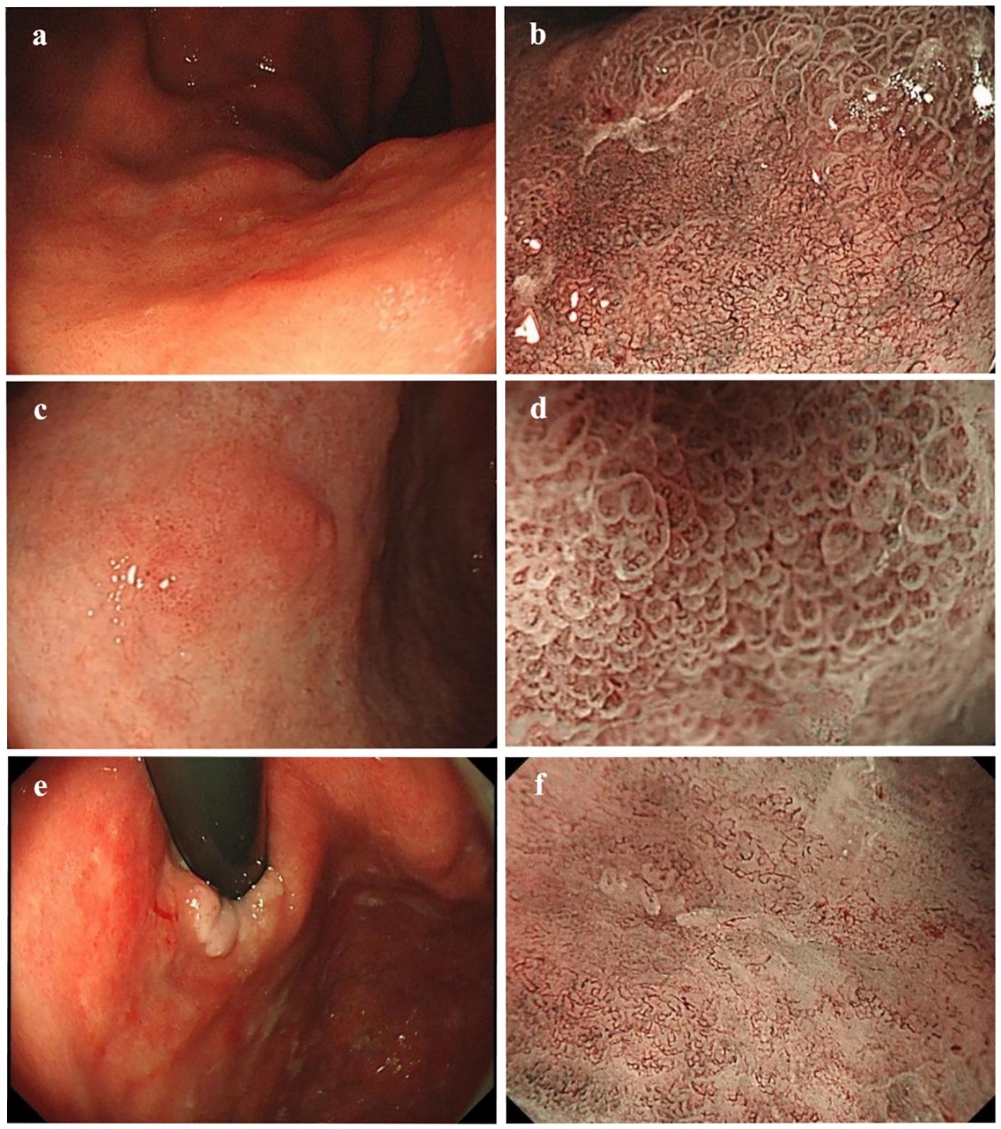 Six endoscopic images labeled a to f show various gastrointestinal linings and textures. Images b, d, and f feature close-up views highlighting detailed mucosal patterns. Images a, c, and e display broader views of the gastrointestinal tract, with image e involving a medical instrument.