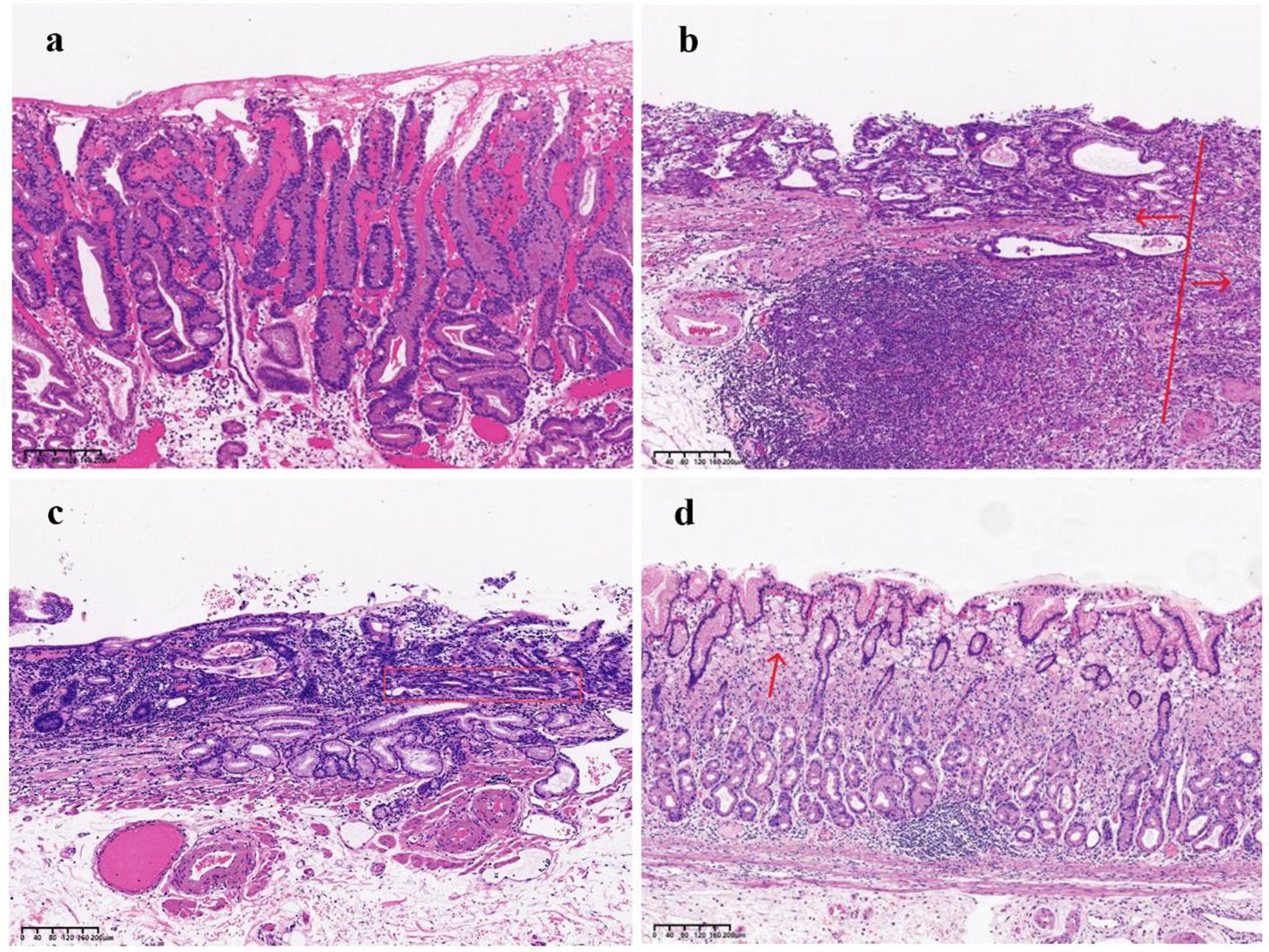 Histological images show tissue sections under a microscope, stained with hematoxylin and eosin for detail. Panel (a) displays uniform glandular structures. Panel (b) highlights dense cellular infiltration with a red line indicating a specific area. Panel (c) shows irregular glandular formations. Panel (d) features elongated structures with an arrow pointing to a region of interest. Each section shows varying degrees of cellular organization and density.