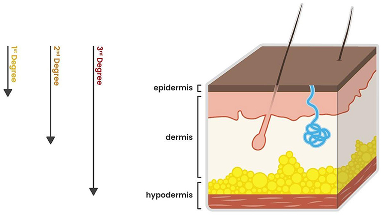 Diagram showing a cross-section of skin layers with arrows indicating burn severity. The layers include the epidermis, dermis, and hypodermis. Arrows indicate that first-degree burns affect the epidermis, second-degree burns extend to the dermis, and third-degree burns reach the hypodermis. Hair follicles and a sweat gland are depicted in the dermis layer.