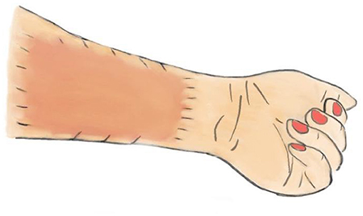 Illustration of a forearm and hand with red-painted nails. Showing the left arm with a distinct rectangular graft, with stitches securing the graft to the patient’s arm. The color is slightly different to the patient’s arm skin.