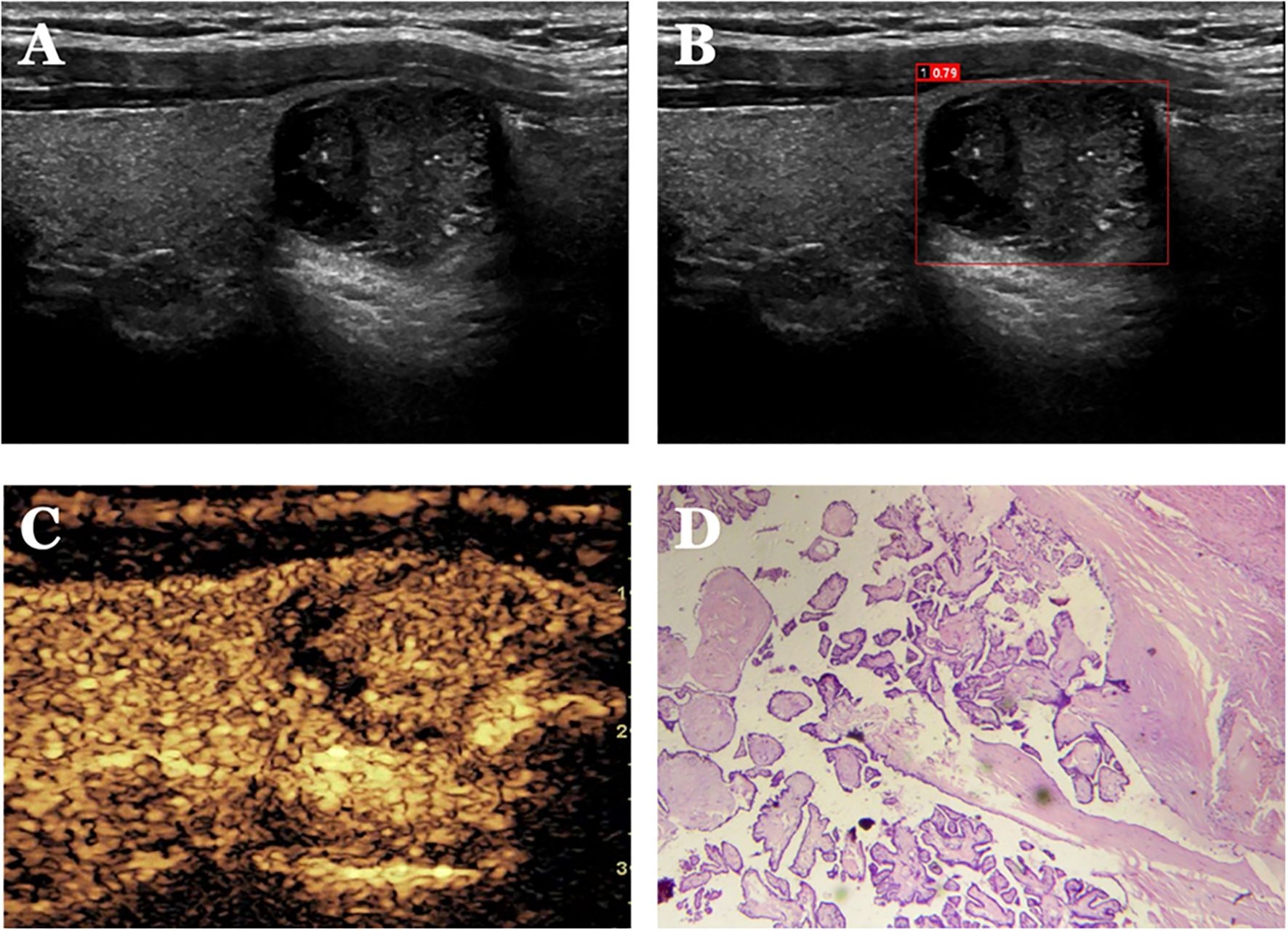 Panel A shows an ultrasound image of a suspicious lesion. Panel B highlights the lesion with a red box and numerical annotation. Panel C displays an enhanced ultrasound image with a different texture. Panel D presents a histological slide with pink and purple stained tissue sections.