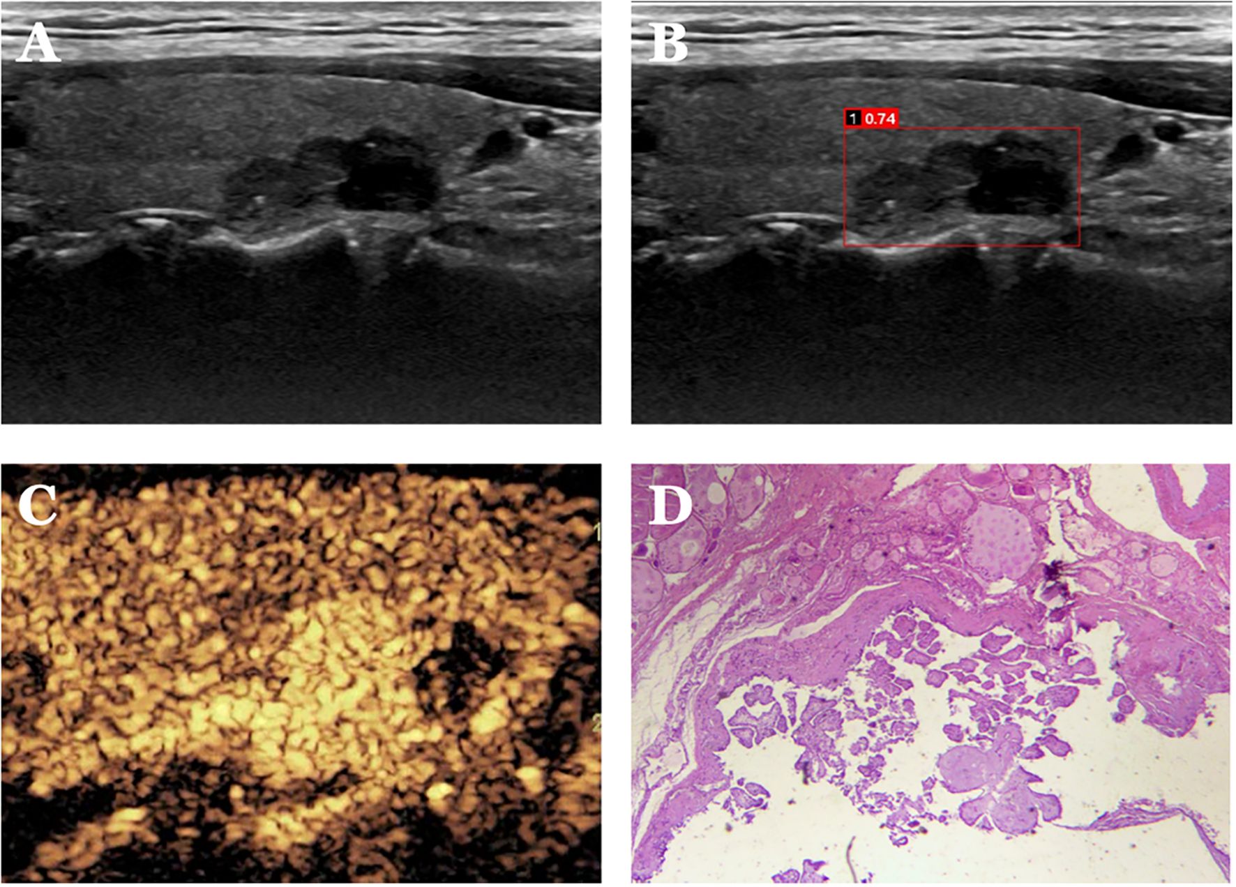 Ultrasound images A and B show a dark mass in soft tissue cross-sections; B includes a measurement of 0.74. Image C depicts a contrast-enhanced scan with textured bright areas, while D is a histological slide showing cellular structures stained in pink and purple.