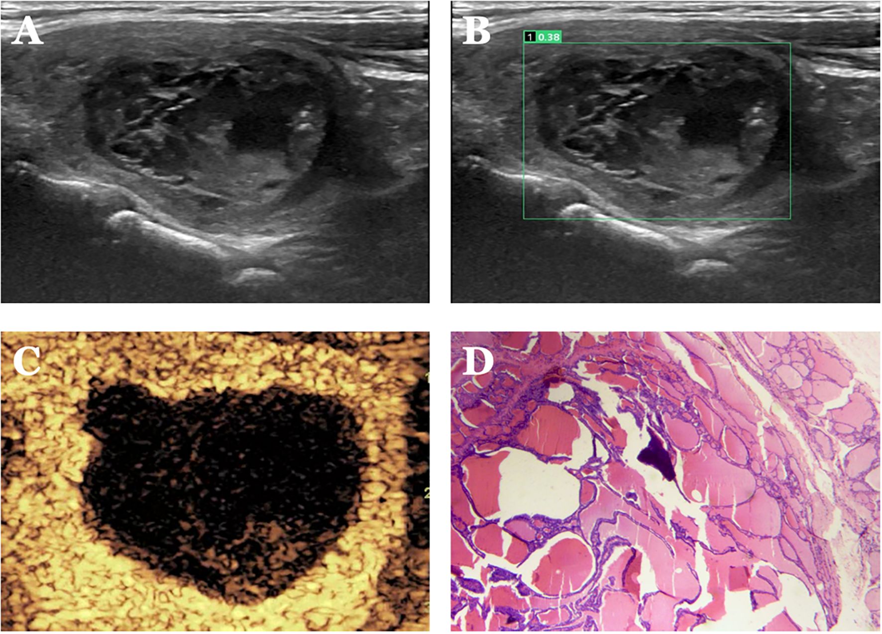 Ultrasound and histology images illustrate different views of tissue structure. Image A shows an unannotated ultrasound scan with a dark region. Image B is a similar ultrasound with a green overlay indicating measurement. Image C presents a detailed textured image with a dark central mass. Image D displays a histological section with purple-stained cellular structures on a pink background.