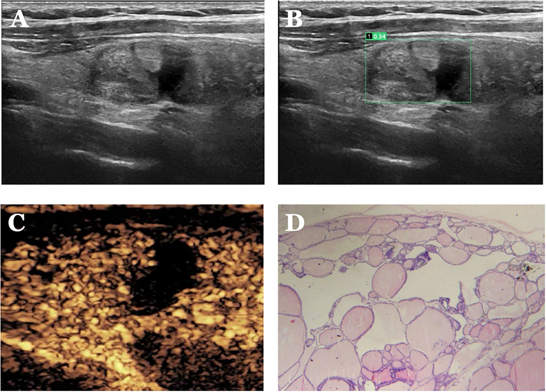 Ultrasound and microscopic images in four panels. Panel A: Ultrasound shows a lesion with irregular shape. Panel B: The same lesion with measurement overlay. Panel C: Enhanced contrast view highlighting the lesion structure. Panel D: Microscopic image showing cellular morphology with numerous vacuoles and defined cells.