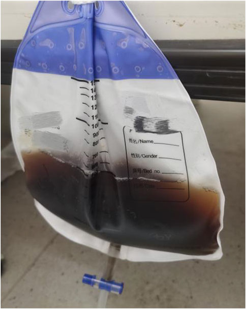A fluid collection bag filled with dark brown liquid, featuring measurement markings and a label section for name, gender, and bed number. The bag is partially transparent, hanging with a blue inlet tube attached.