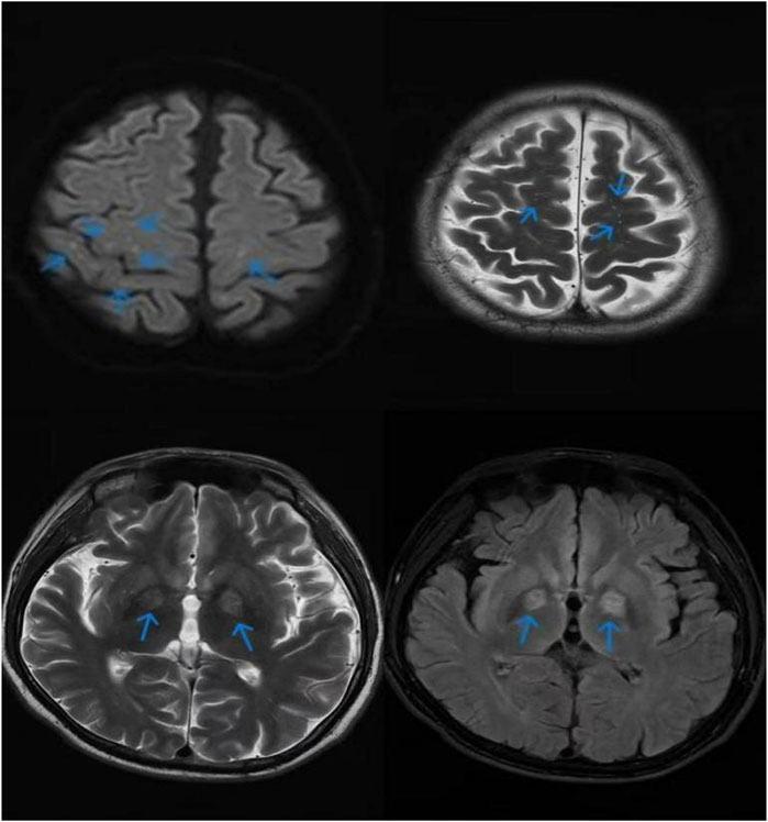 Four MRI brain scans with highlighted areas by blue arrows. The top two images focus on the cerebral cortex, while the bottom two emphasize deeper brain structures. These arrows may indicate regions of interest or abnormality.