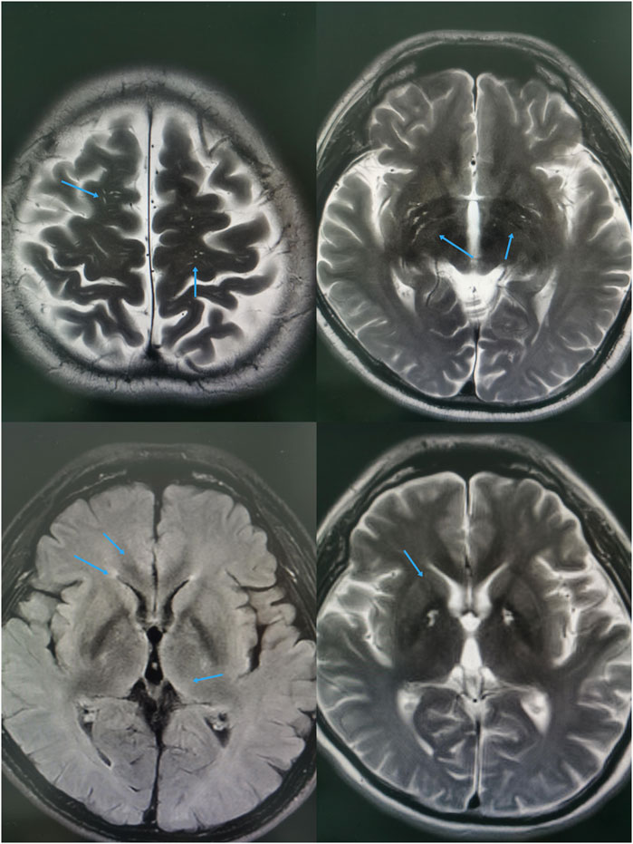 Four-panel MRI images of a brain with blue arrows indicating specific regions. The images show different cross-sectional views, highlighting distinct areas of interest with varying degrees of contrast and texture within the brain tissue.