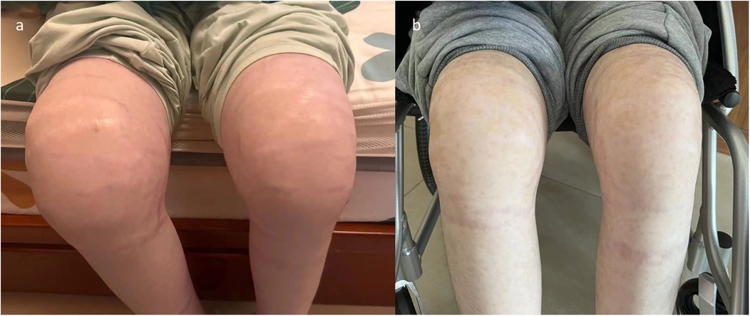 Two images comparing the knees of an individual. Image \