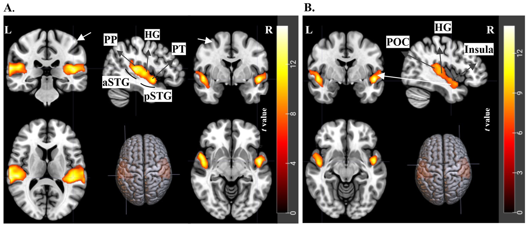 MRI brain scans showing activation patterns in different regions. Panel A highlights the aSTG and pSTG with adjacent labels like PP, HG, and PT. Panel B focuses on regions such as POC and the insula, also highlighting HG. The images use a color scale to represent different t-values, indicating levels of neural activity.