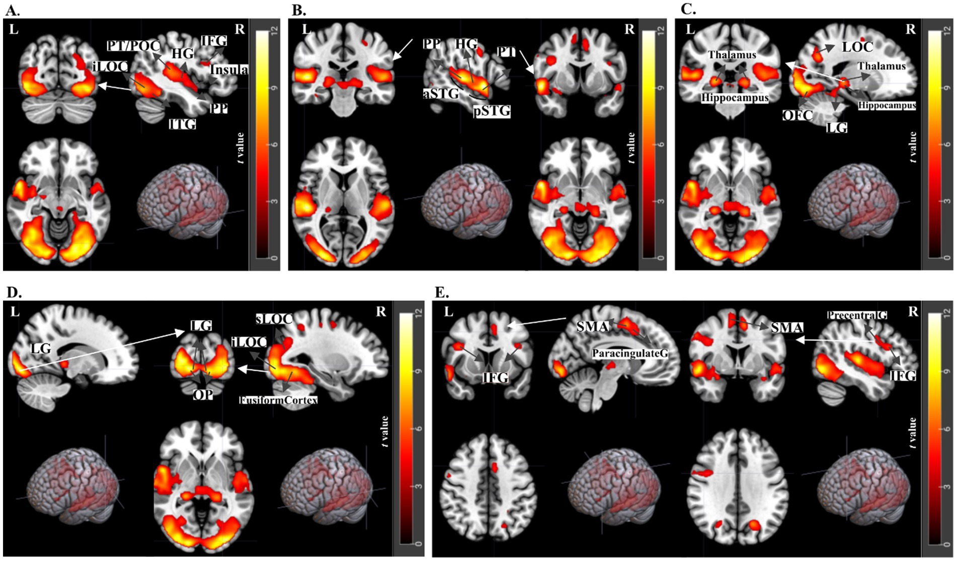 Five panels labeled A to E display brain scans with different highlighted areas, indicating activation regions through color gradients ranging from yellow to red. Each panel’s scan is labeled with anatomical structures like insula, thalamus, hippocampus, and more, showing lateral (L) to right (R) orientations. Colored bars beside each panel denote the t-value scale. Each includes 3D brain models highlighting the activated regions.