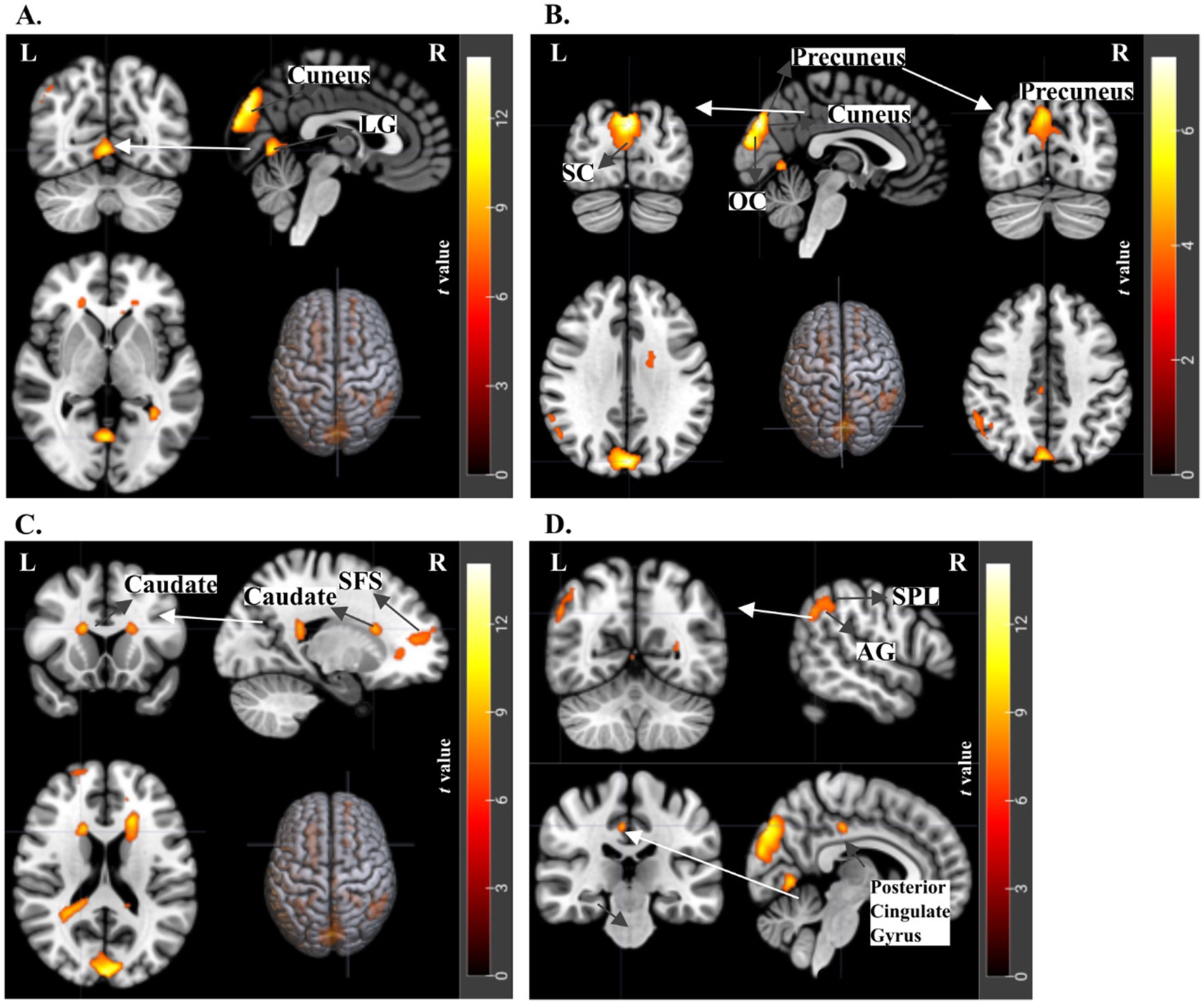 Four panels labeled A to D show brain scans with highlighted areas. Panel A highlights the cuneus and lingual gyrus. Panel B focuses on the precuneus, cuneus, superior colliculus, and occipital cortex. Panel C features the caudate and superior frontal sulcus. Panel D shows the superior parietal lobule, angular gyrus, and posterior cingulate gyrus. Each panel includes a color scale indicating t-values, with brain images displaying activation areas.