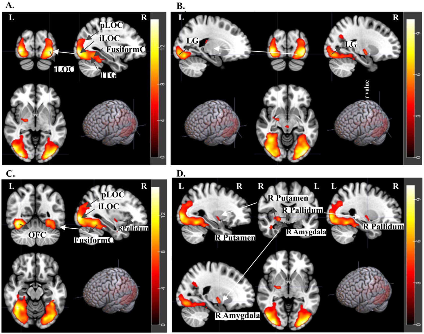 Brain imaging panels displaying activated regions marked in color on MRI scans. Panel A highlights pLOC, iLOC, Fusiform Cortex, and ITG. Panel B shows the LG region. Panel C includes pLOC, iLOC, Pallidum, and OFC. Panel D focuses on the R Putamen, R Pallidum, and R Amygdala. Color scales on the right indicate activation intensity.