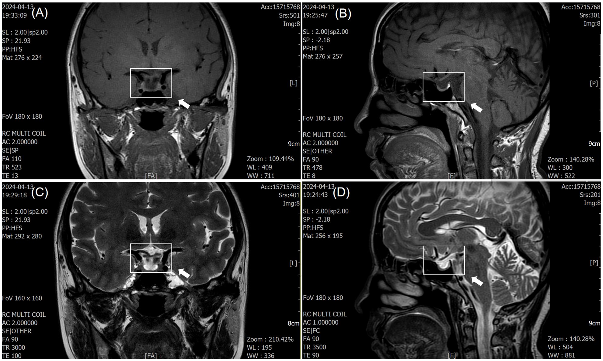 MRI scans of a brain showing coronal (A, C) and sagittal (B, D) views. Each section is labeled with technical details, and white arrows indicate regions of interest within marked rectangles. Scans display different imaging parameters like slice thickness and positioning.
