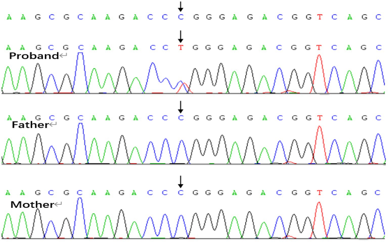 Genetic sequencing graph showing nucleotide variations among a proband, father, and mother. The proband graph reveals a red peak representing a T nucleotide at a specific position, indicating a mutation. The father and mother's graphs show normal sequences without this mutation, represented by blue peaks for C nucleotides in the same position.