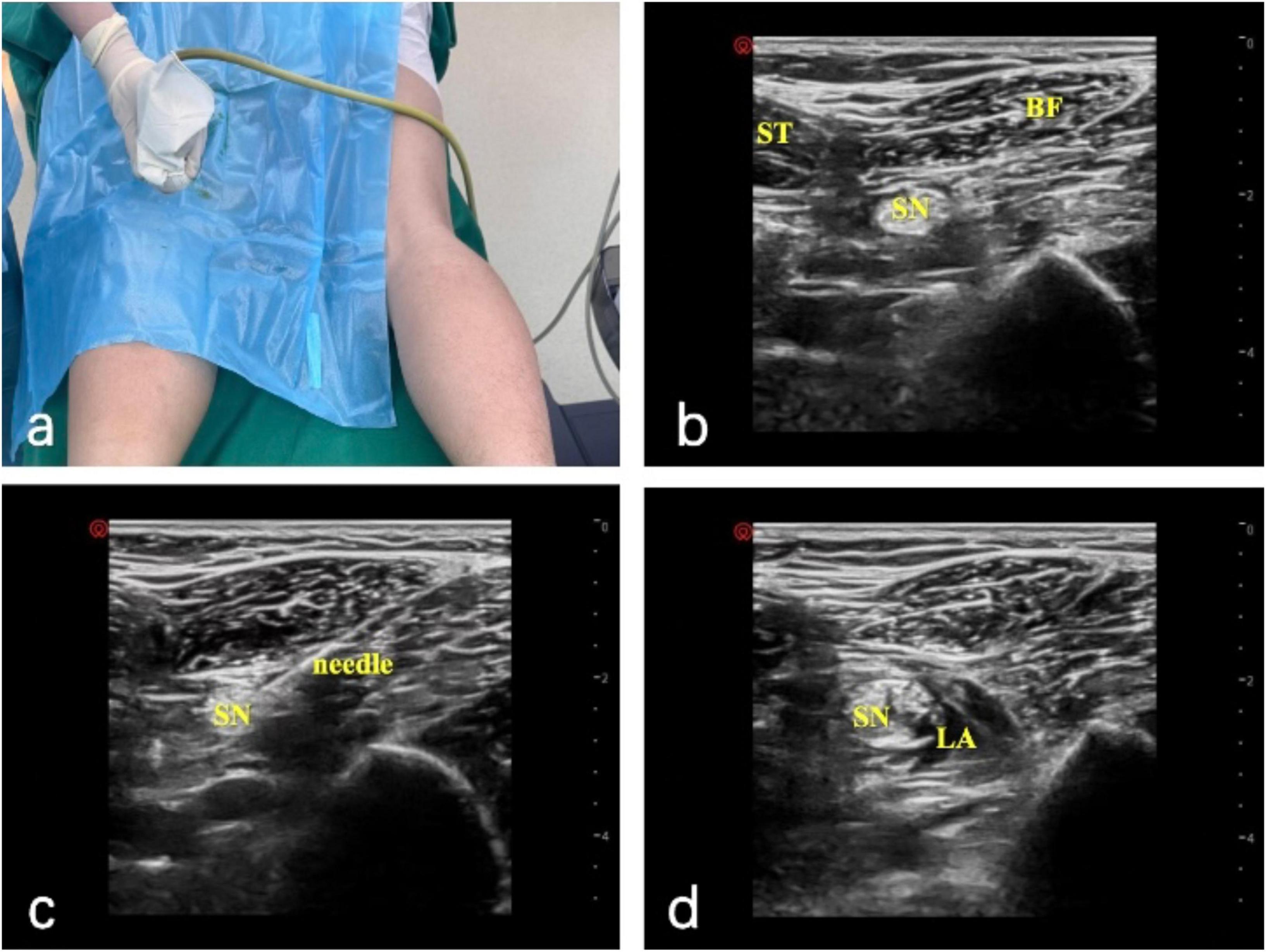 Panel a shows a medical procedure with a healthcare professional holding an ultrasound probe near a patient’s thigh. Panel b is an ultrasound image showing the semitendinosus (ST), biceps femoris (BF), and sciatic nerve (SN). Panel c shows an ultrasound image with a needle approaching the sciatic nerve (SN). Panel d displays an ultrasound image of the sciatic nerve (SN) surrounded by local anesthetic (LA).