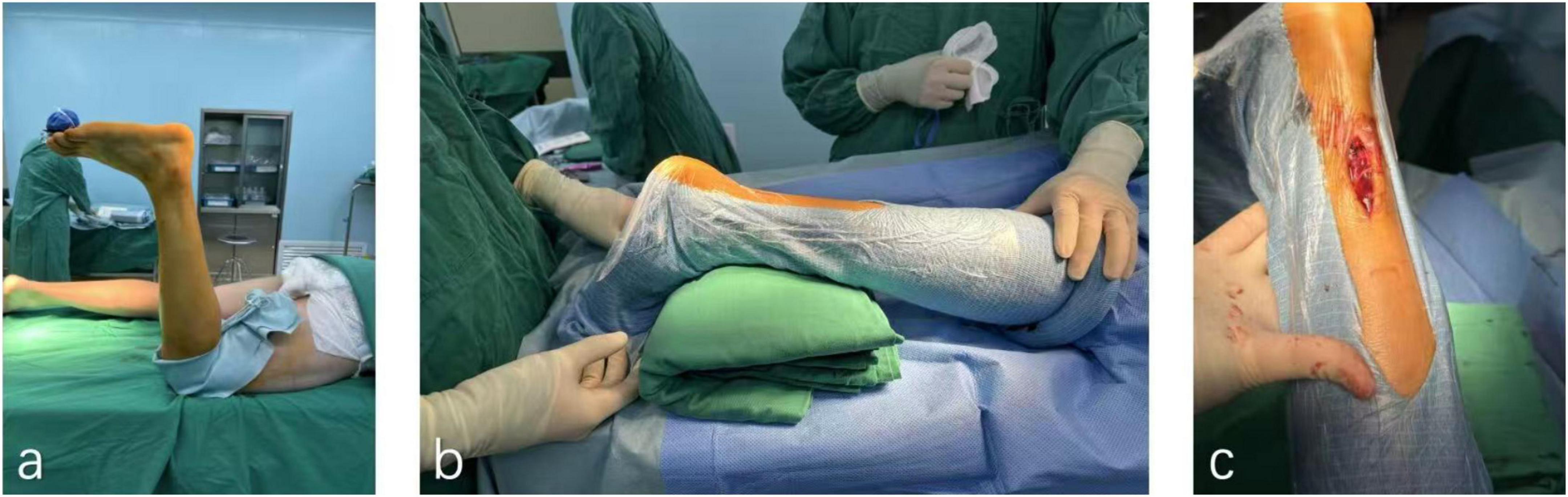 a) A patient’s leg is elevated and prepped for surgery in an operating room. b) Two medical staff positions the leg, supported by a green cushion, draped in a sterile covering. c) A close-up of the leg with an incision revealing underlying tissue.