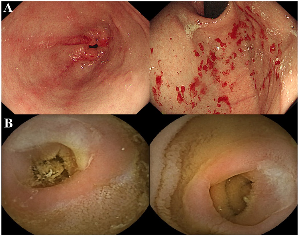 Two panels in an endoscopic image. Panel A: Shows inflammatory changes with redness and bleeding in the esophagus. Panel B: Displays two views of a worm in the duodenum, clearly visible against the mucosal surface.