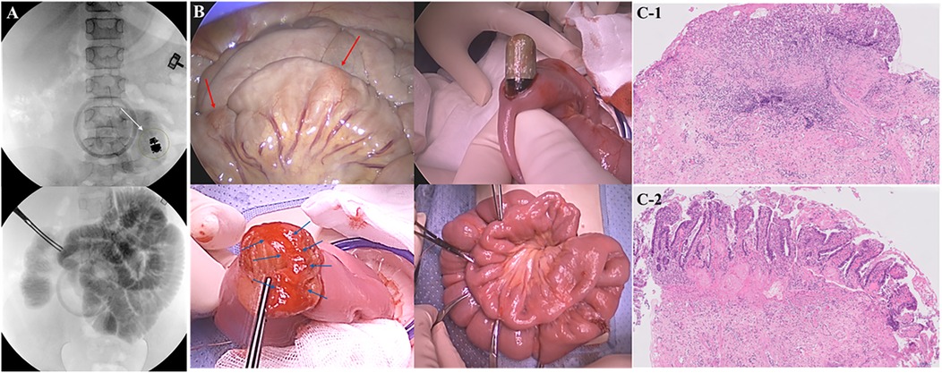 A series of medical images showing a fluoroscopic view of an intestinal blockage, surgical images of the intestine with visible pathology, and histological slides illustrating tissue samples with cellular details. Panels are labeled A, B, and C, displaying various steps in diagnosing and analyzing gastrointestinal issues.