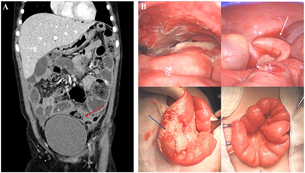 Panel A shows a CT scan with a red arrow indicating an area of interest in the abdomen. Panel B includes three images: the top left shows the interior of a body cavity, the top right has a white arrow pointing at part of the intestinal wall, and the bottom image displays a section of the intestines with a blue arrow highlighting a specific area.