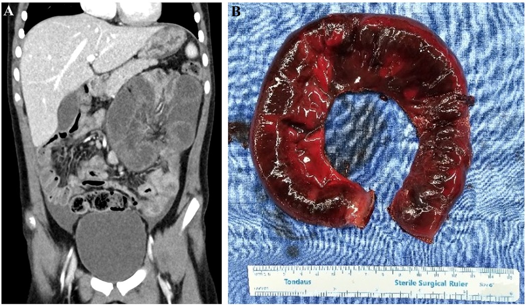 Panel A shows a coronal CT scan of the abdomen, highlighting the distended intestinal closed loop on the left side. Panel b displays a surgically removed segment of small bowel.