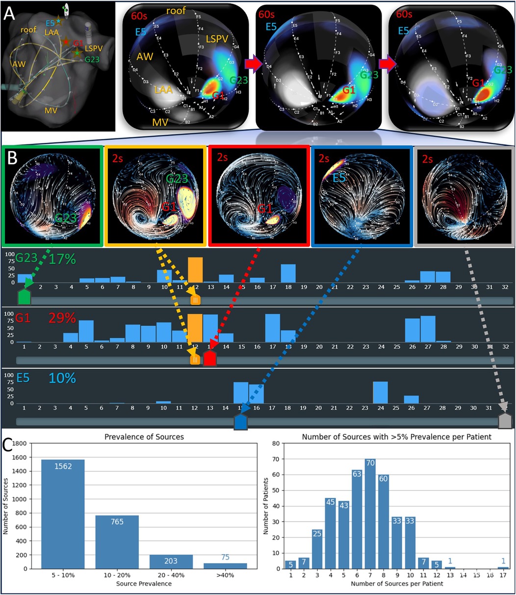 Panel A shows a heart diagram with highlighted areas labeled G1, G23, and E5. Panel B exhibits flow visualizations and corresponding bar charts linked by arrows, indicating prevalence percentages (G23: 17%, G1: 29%, E5: 10%). Panel C contains two bar graphs. The left graph displays source prevalence categories and frequencies: 5-10% (1562), 10-20% (765), 20-40% (203), >40% (75). The right graph shows the number of sources with >5% prevalence per patient, peaking at 60 patients with seven sources.