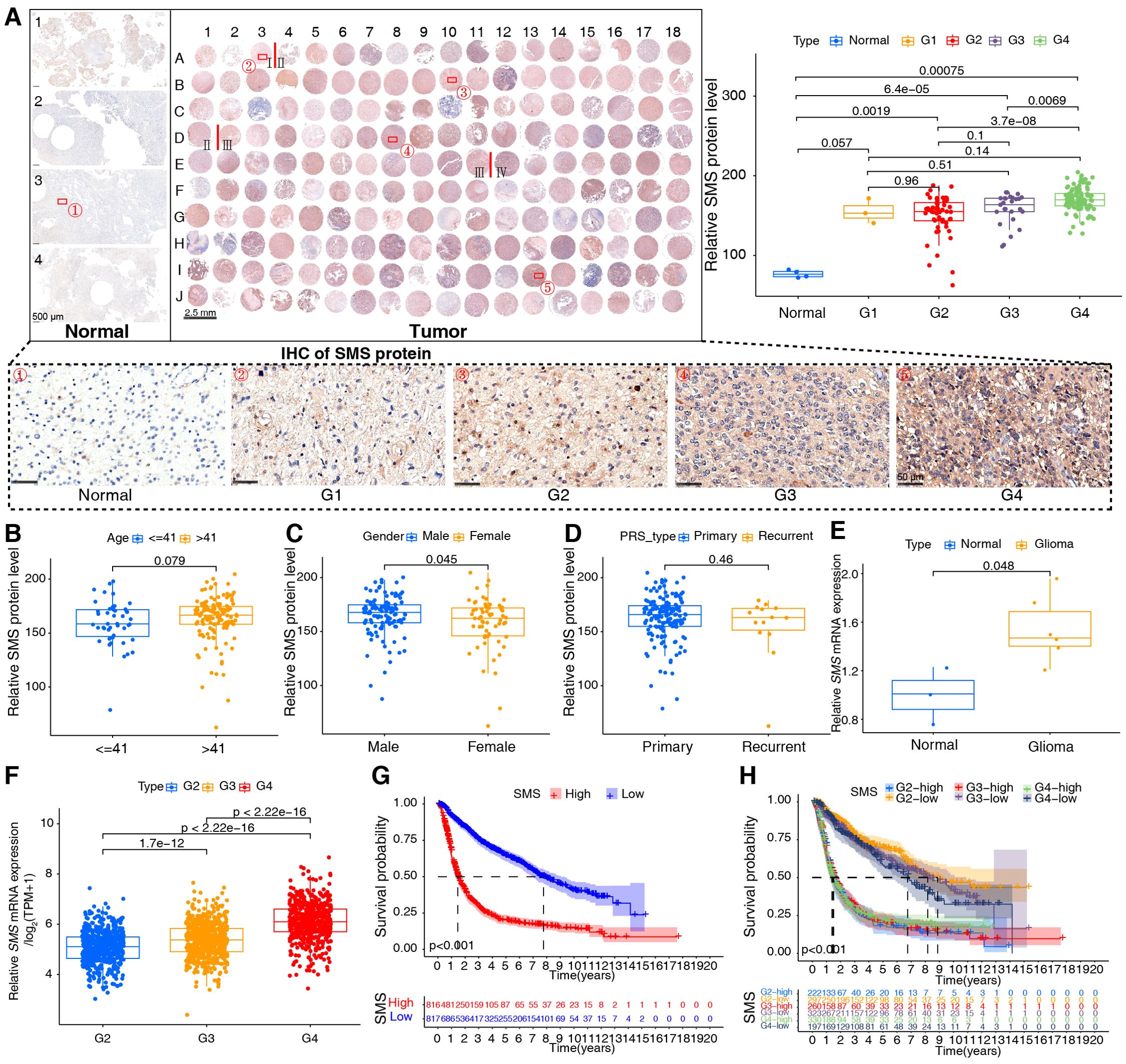 Panel A shows histological images of normal and tumor tissues with varying levels of SMS protein staining. Graphs B to F present box plots comparing SMS protein and mRNA levels by age, gender, tumor type, and expression levels, revealing significant differences. Graph G shows a survival probability chart comparing high and low SMS expression groups, indicating poorer survival with high expression. Graph H presents survival probabilities for various SMS expression levels across tumor grades, highlighting significant survival differences.